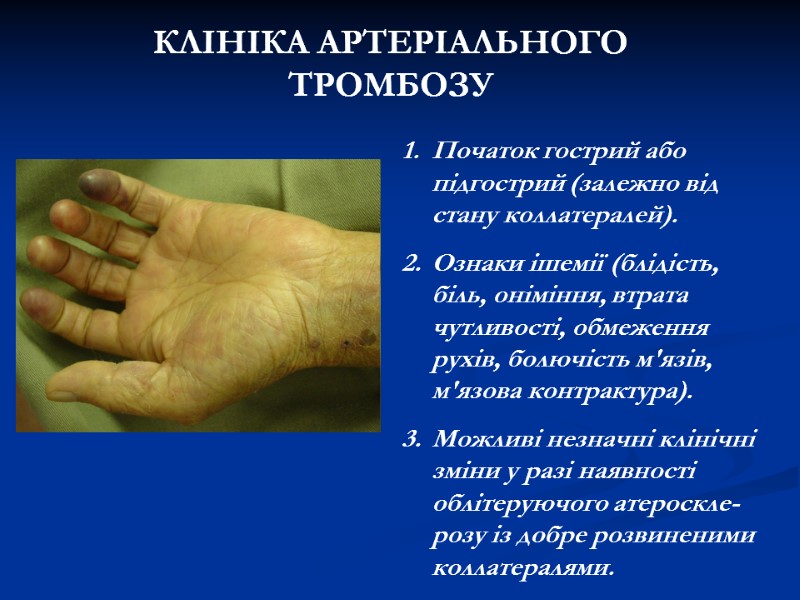 КЛІНІКА АРТЕРІАЛЬНОГО ТРОМБОЗУ Початок гострий або підгострий (залежно від стану коллатералей). Ознаки КЛІНІКА АРТЕРІАЛЬНОГО ТРОМБОЗУ Початок гострий або підгострий (залежно від стану коллатералей). Ознаки